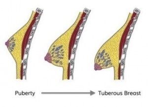 tuberous breasts