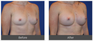 Breast Implant Before and After | Dr Zachary Farris