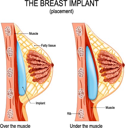 Tight Cleavage without Symmastia: Fat Grafting and Implants for