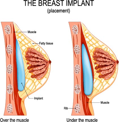 What Is Breast Augmentation & What Are The Different Types? Luxor Hospital