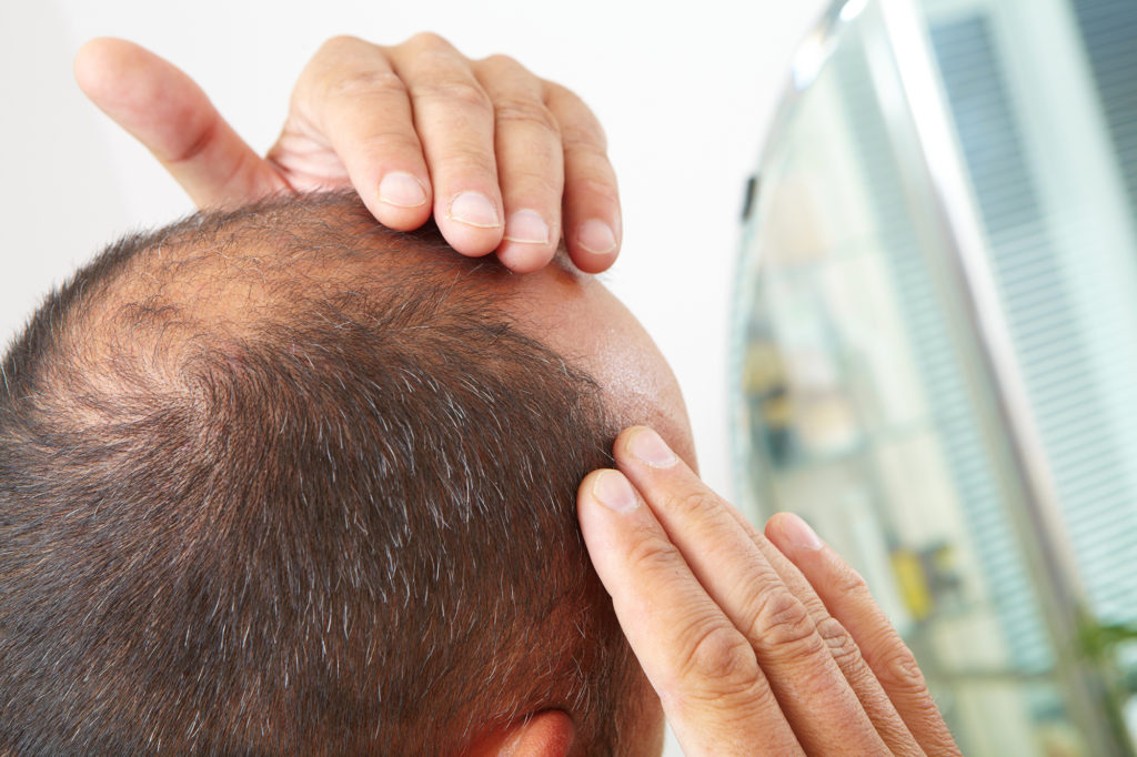 Balding Man Looking at Hair Loss in Mirror