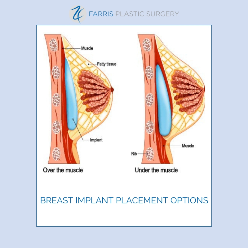 Breast implant placement