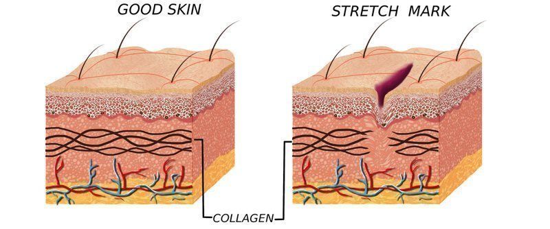 Stretch Mark Illustration