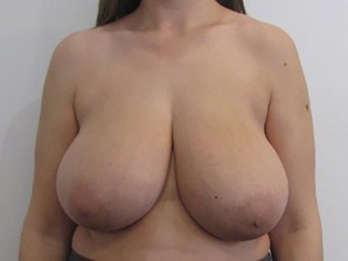 before Breast Reduction Dallas TX