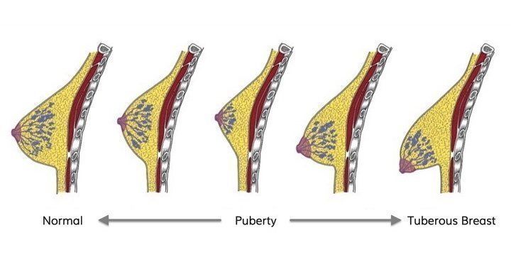 What is a Tuberous Breast Deformity? - Dr Zachary Farris