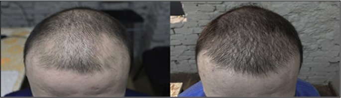 before and after HairMedica Plano TX