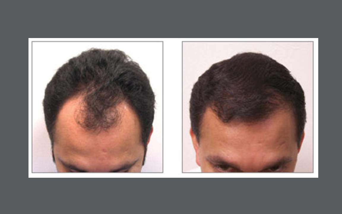 Hair Restoration Expert in Dallas, Texas | Hair Transplantation