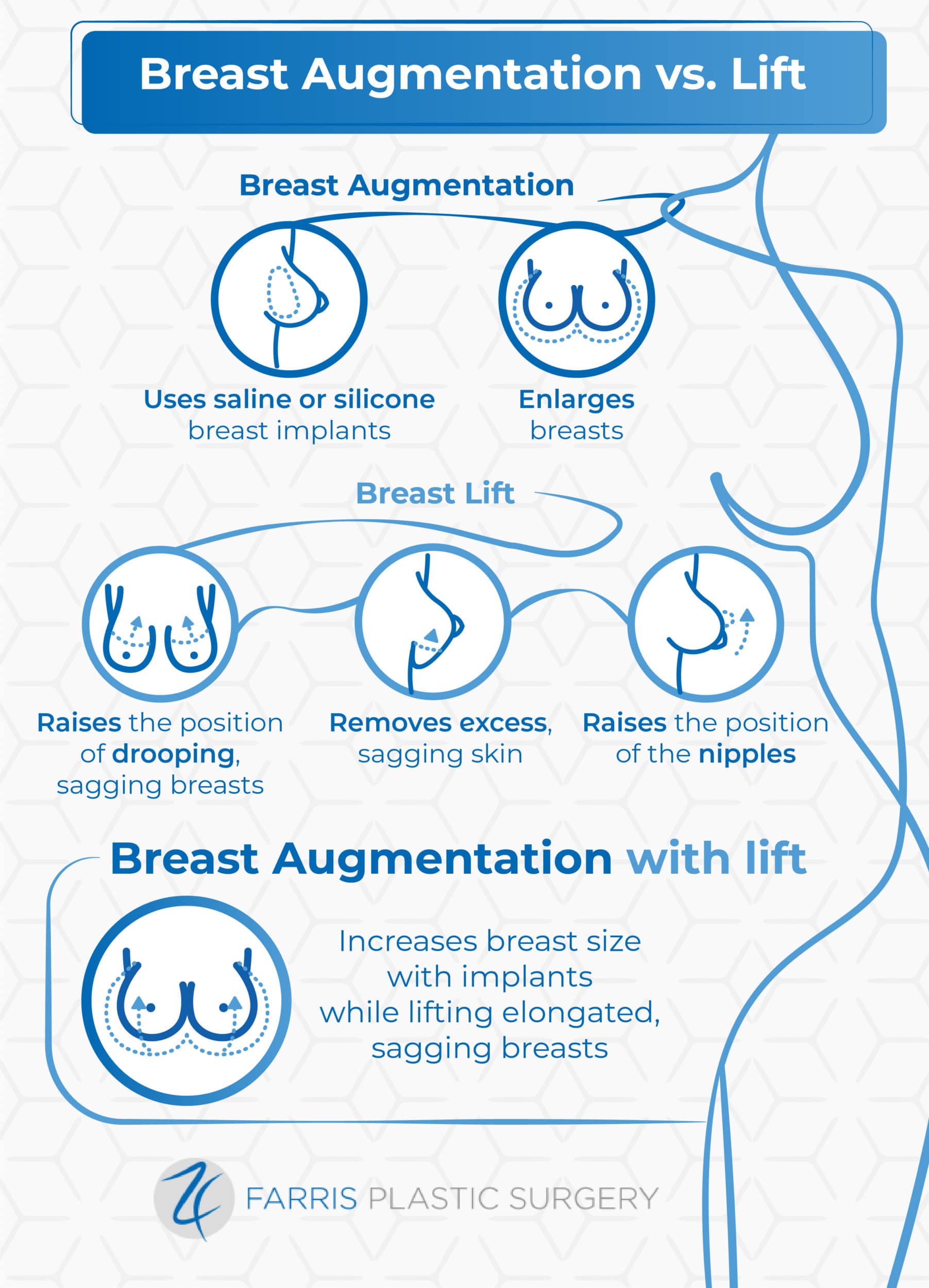 Breast Augmentation with implants Plano TX