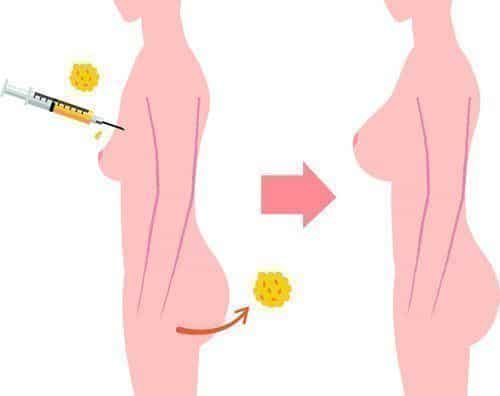 Breast Implant Surgeon Plano TX