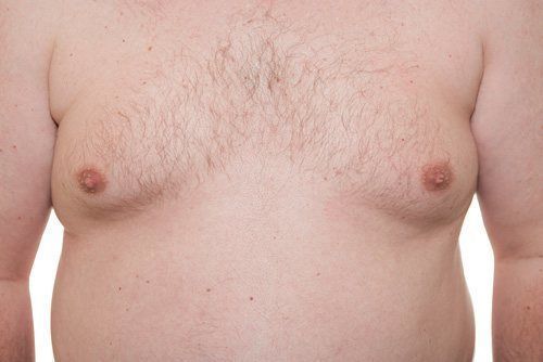 Male Breast Reduction