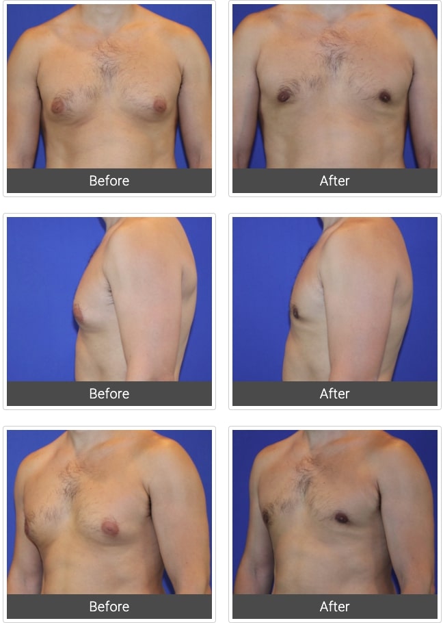 man’s chest before and after gynecomastia breast reduction surgery from multiple angles, with no male breasts after procedure
