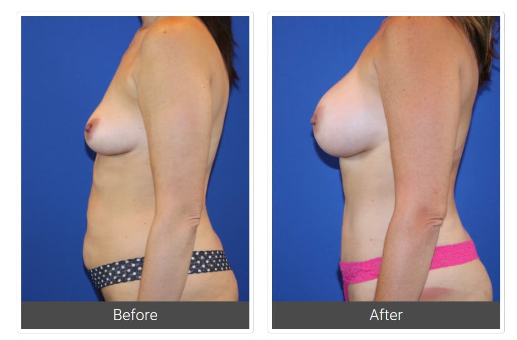 before and after mommy makeover Dallas TX