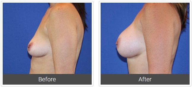before and after Breast Augmentation Dallas TX