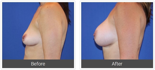 breast augmentation before and after