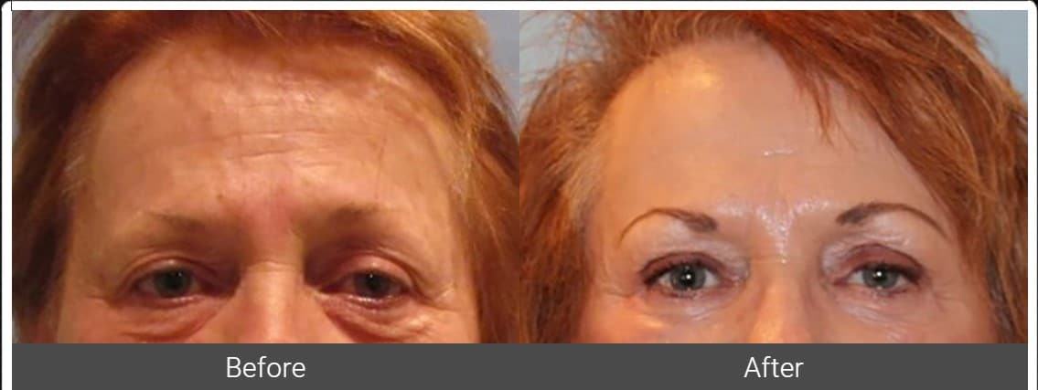woman’s eyes before and after blepharoplasty eyelid surgery, with less bags and wrinkles after treatment