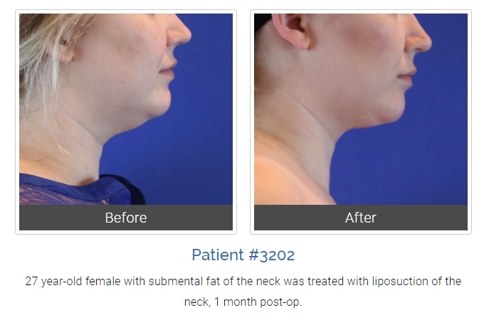 liposuction before and after photo