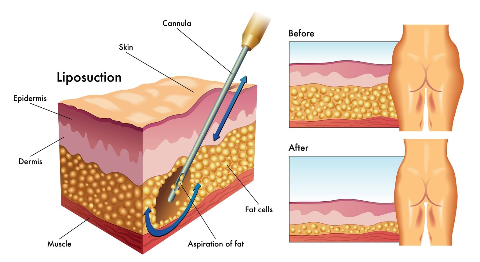 liposuction illustration