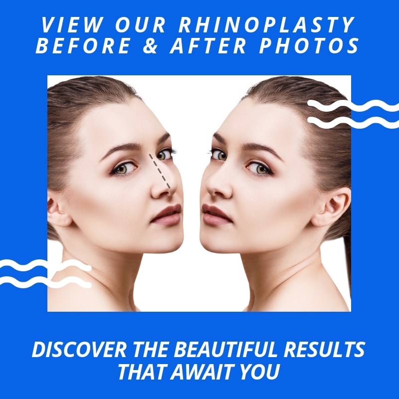 before and after Rhinoplasty Dallas TX