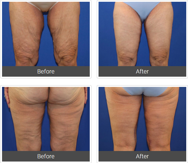 Before and after images of Dr. Farris's thigh lift patient