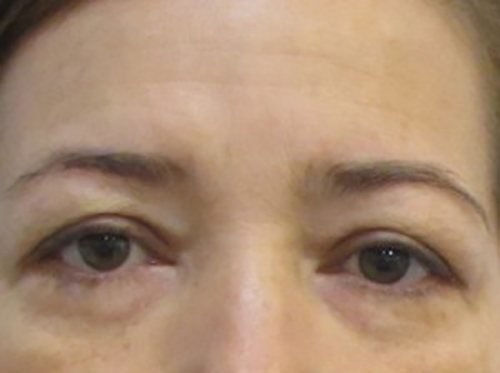 Before Image: Patient Case #3054 - front