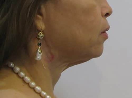 Before Image: Patient Case #2992 - right-side