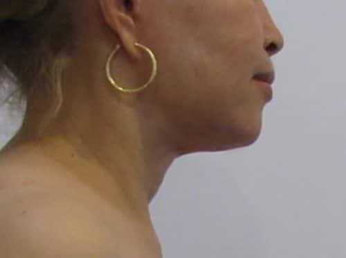 After Image: Patient Case #2992 - right-side
