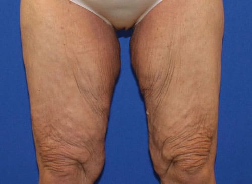 Before Image: Patient 1 - front