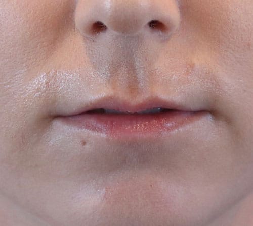 Before Image: Patient #1001 - front