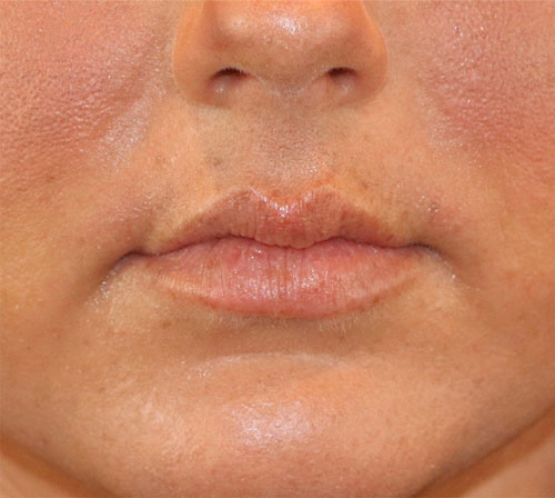 Before Image: Case #1002 - front