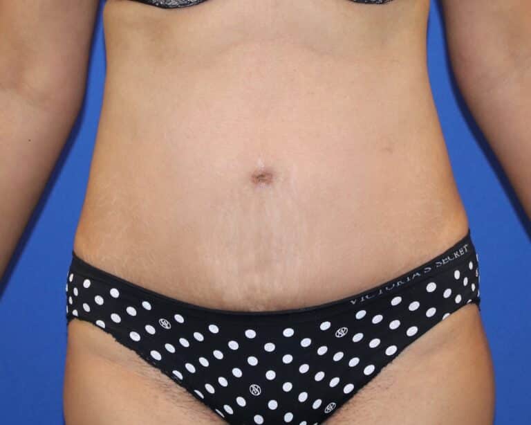 After Image: Patient Case #3867 - front