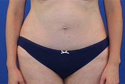 After Image: Patient Case #3989 - front