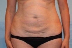 Before Image: Patient Case #3989 - front