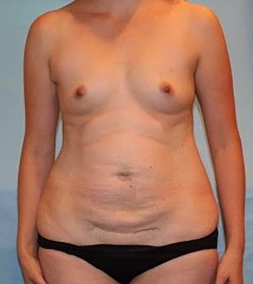 Before Image: Patient Case #3023 - front