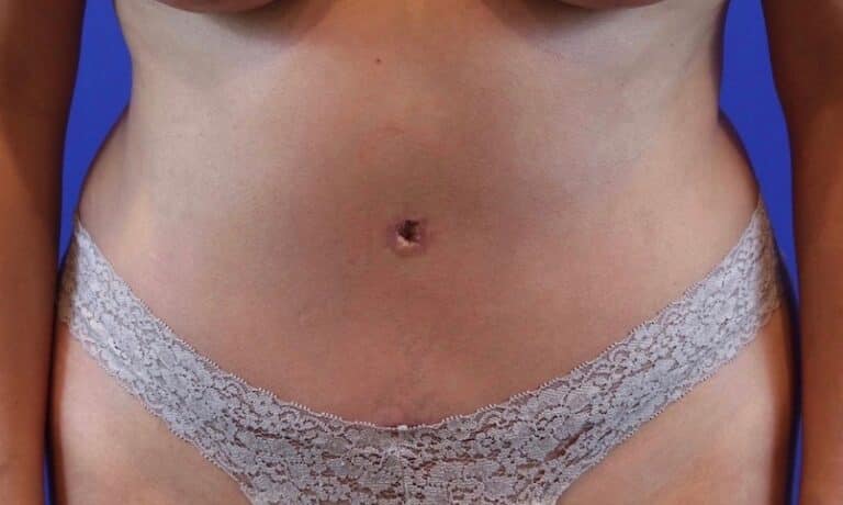 After Image: Patient Case #3776 - front