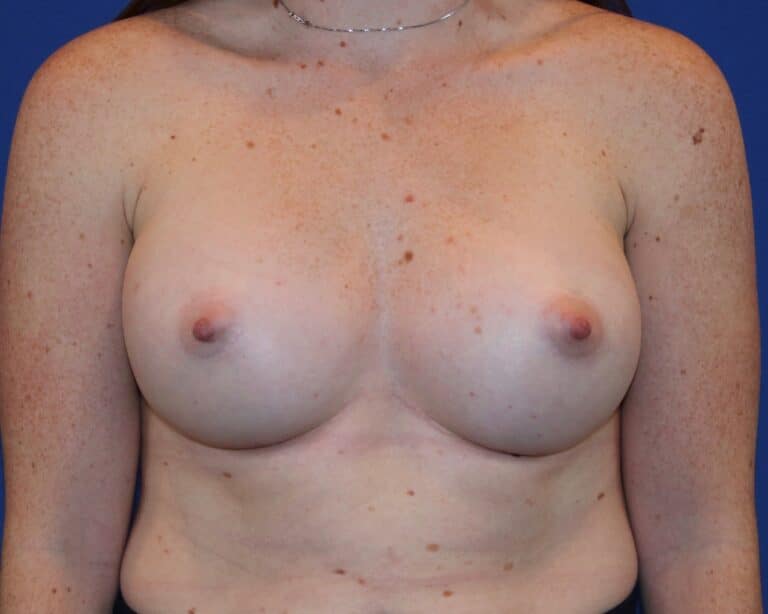 After Image: Patient Case #2907 - front