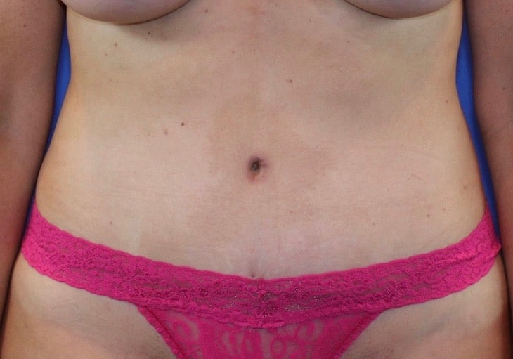After Image: Patient Case #3871 - front