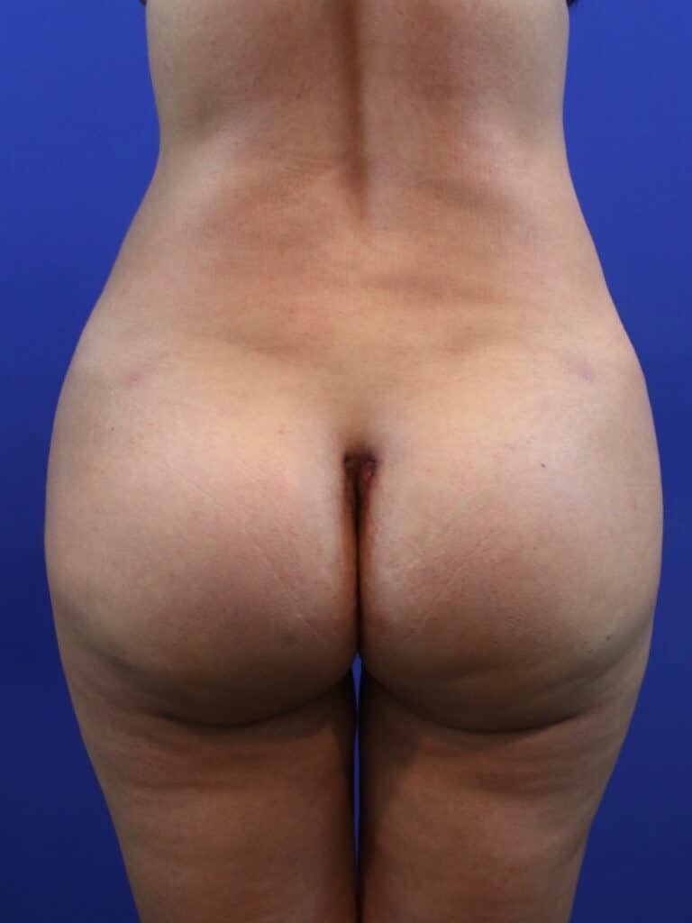 After Image: Patient Case #4012 - front