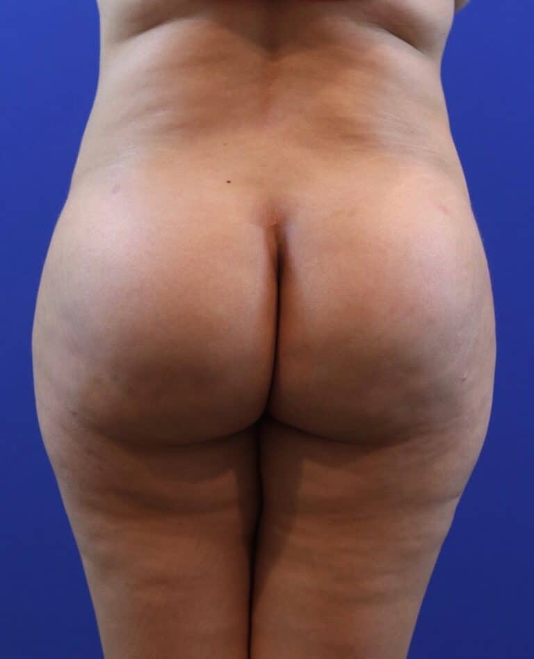 After Image: Patient Case #4002 - back