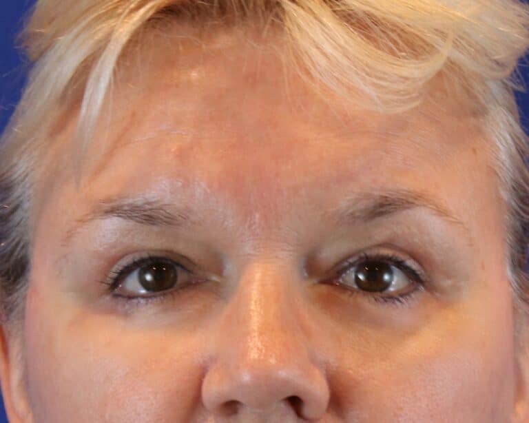 After Image: Patient Case #3068 - front
