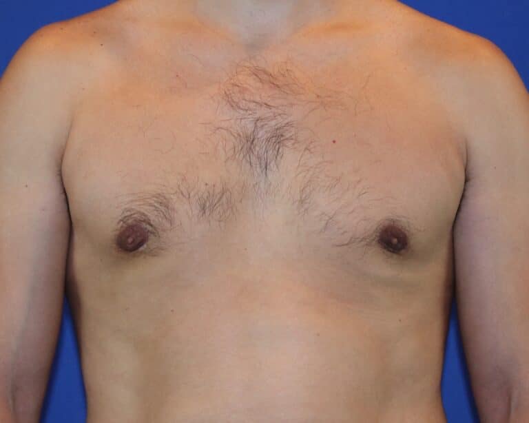 After Image: Patient Case #1053 - front