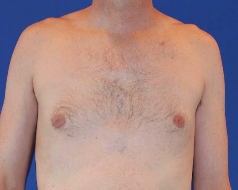 After Image: Patient Case #1049 - front