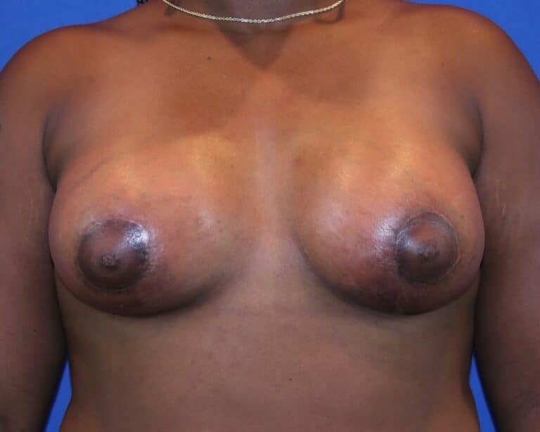 After Image: Patient Case #3920 - front