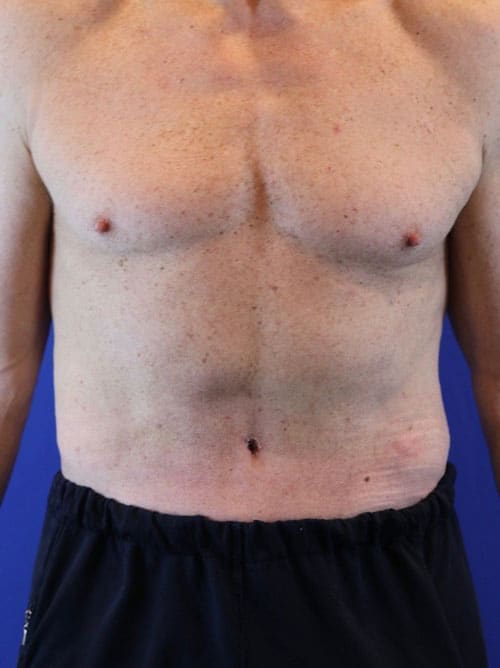 After Image: Patient Case #3990 - front