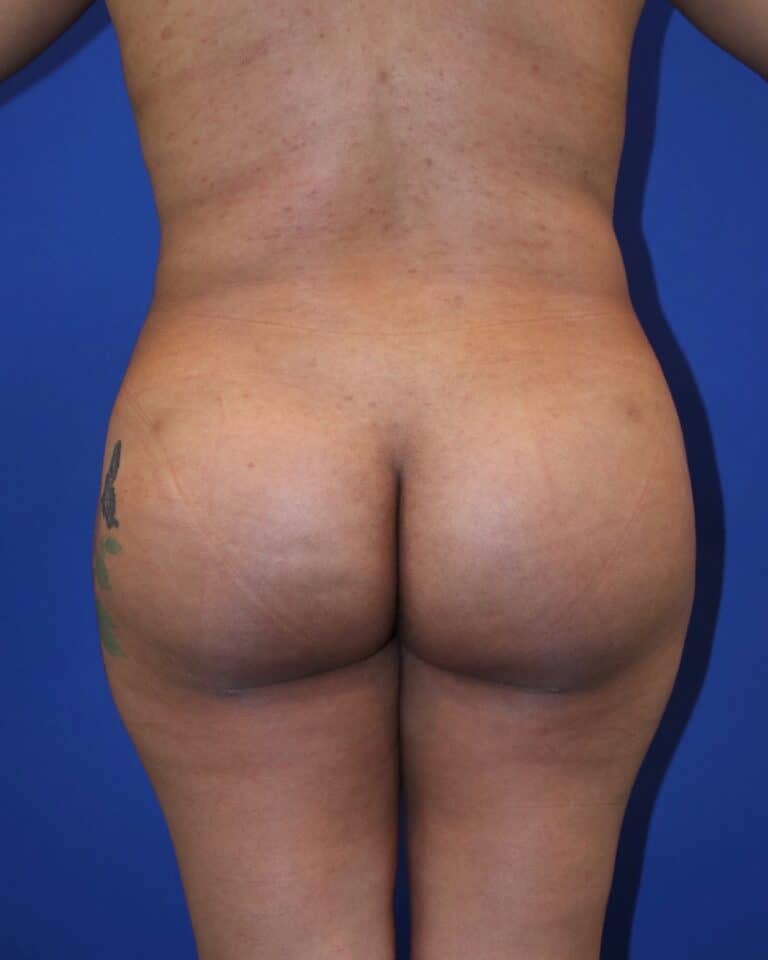 After Image: Patient Case #4009 - front