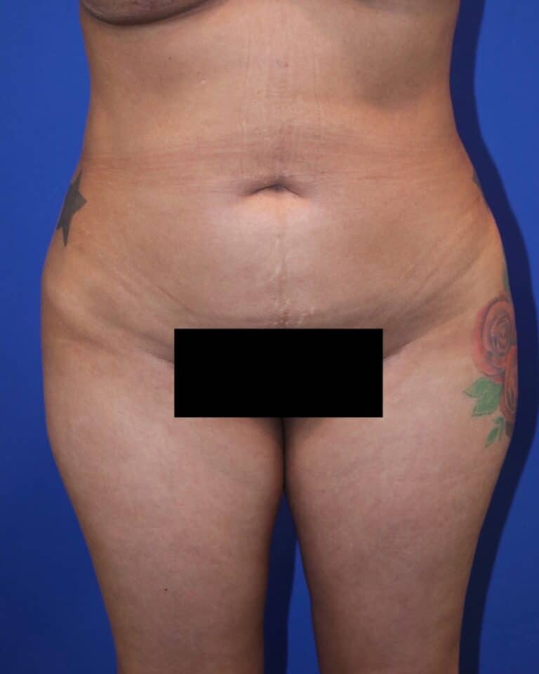 After Image: Patient Case #3214 - front