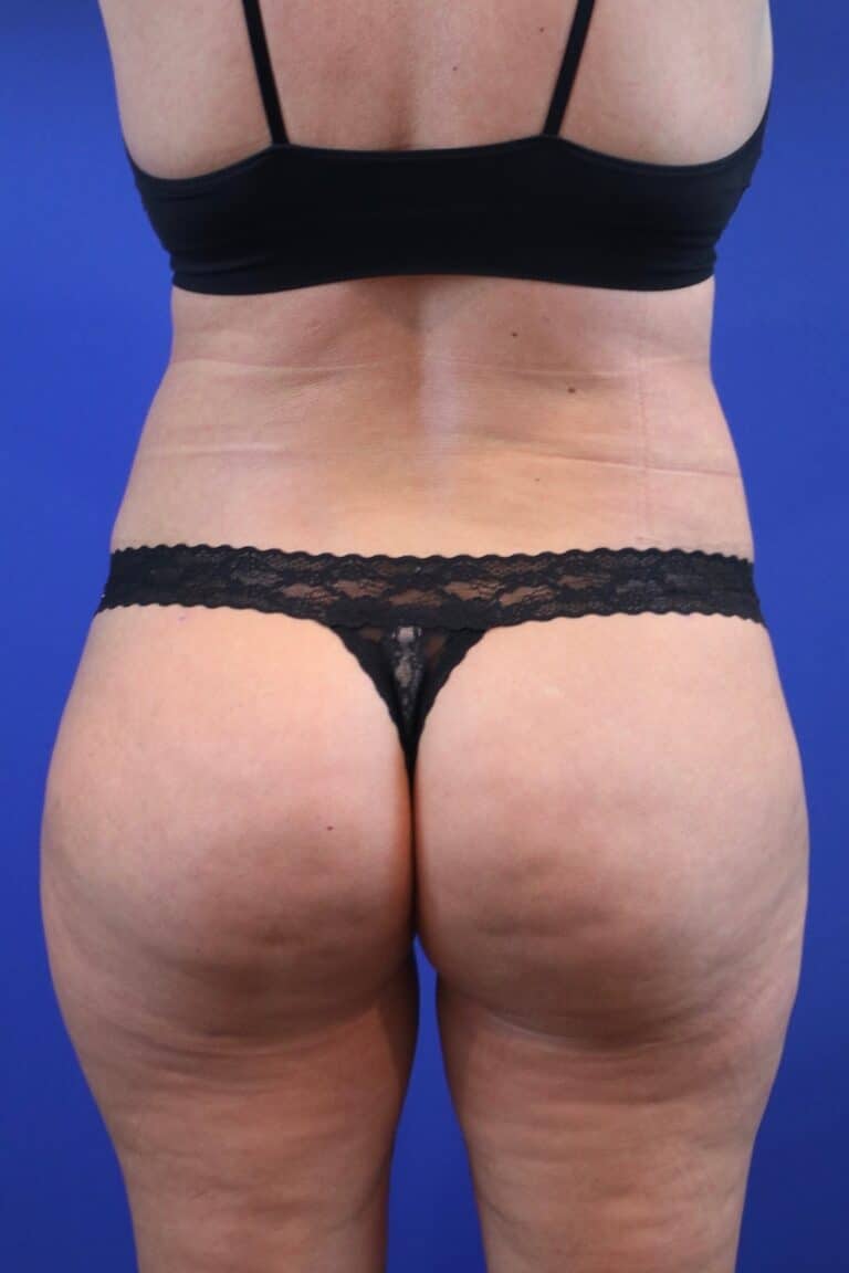 After Image: Patient Case #4010 - front