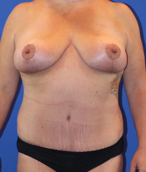 After Image: Patient Case #3006 - front