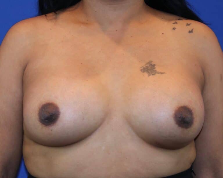 After Image: Patient Case #5749 - front