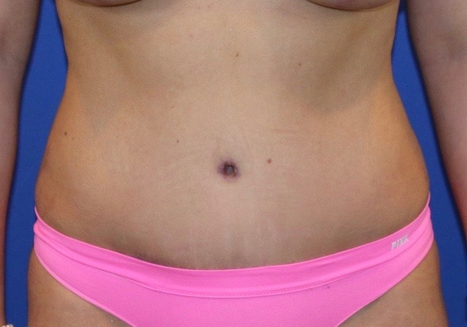 After Image: Patient Case #3890 - front