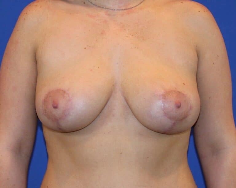 After Image: Patient Case #3862 - front
